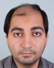 Before Hair Transplant &nbsp;Front